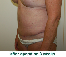 plastic-surgery-tummy-tuck
